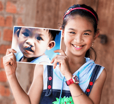 Young girl holding a before cleft surgery photo in front of his smiling post surgery smile. Photo cred: Operation Smile
